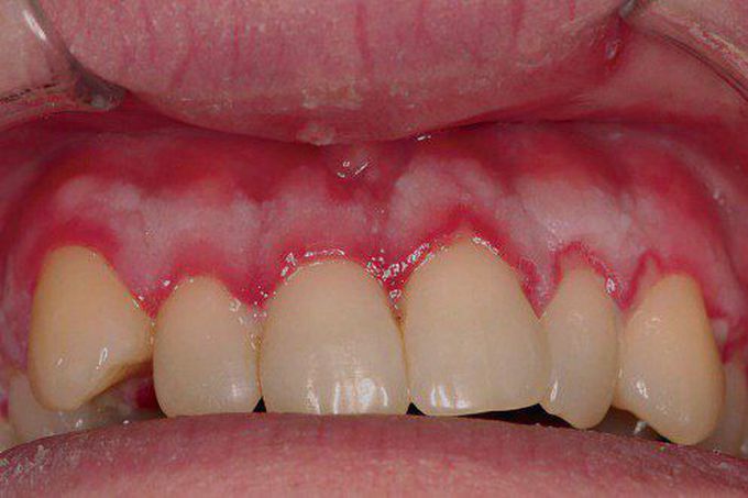 Acute Herpetic

Gingivostomatitis
Maxillary facial gingiva with erythema and focal marginal erosions.