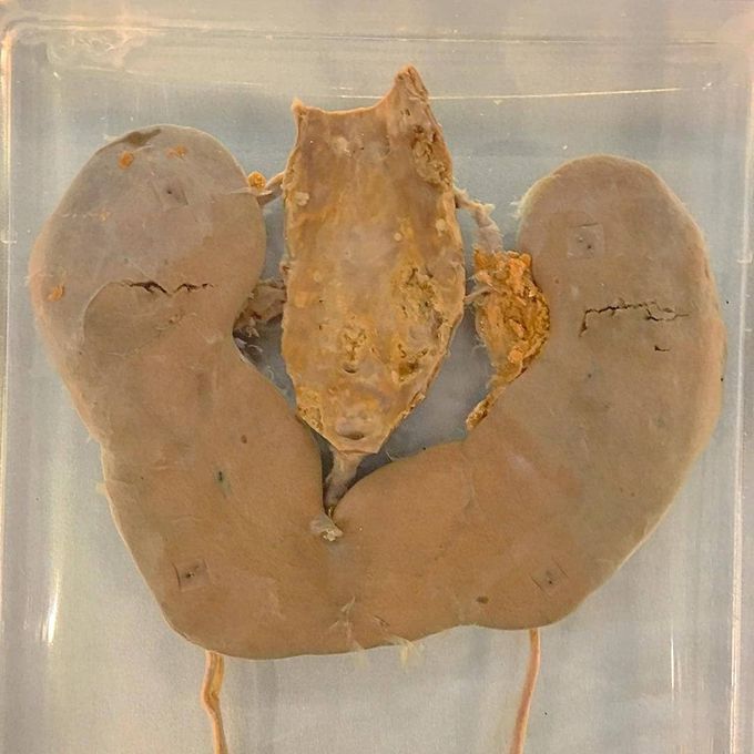 Horseshoe kidney