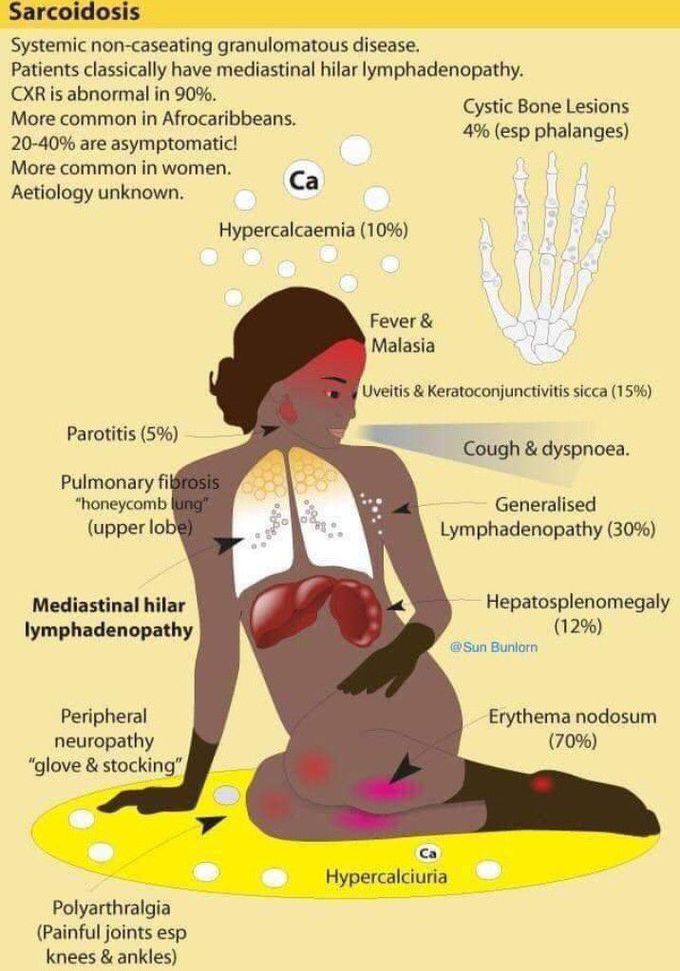 Sarcoidosis in a pic