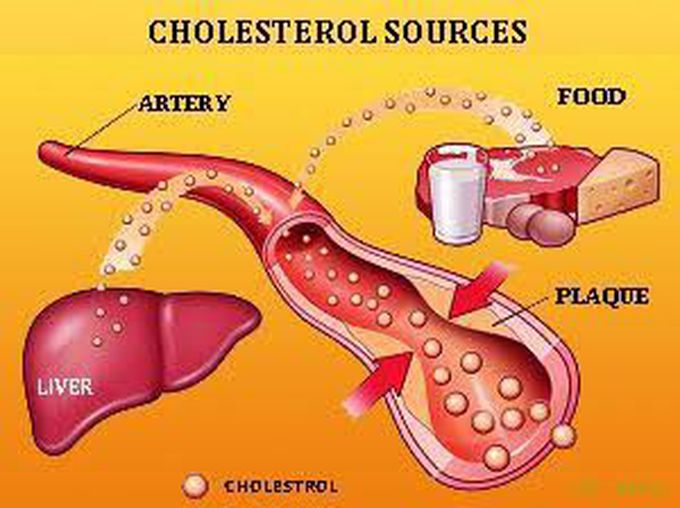 Hyperlipidemia symptoms