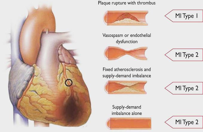 Myocardial Infarction types