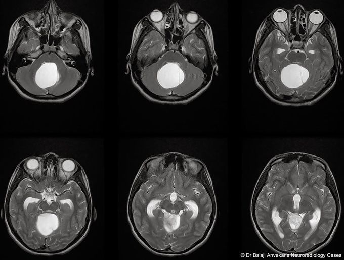 Pilocytic astrocytoma or juvenile pilocytic astrocytoma or cystic cerebellar astrocytoma