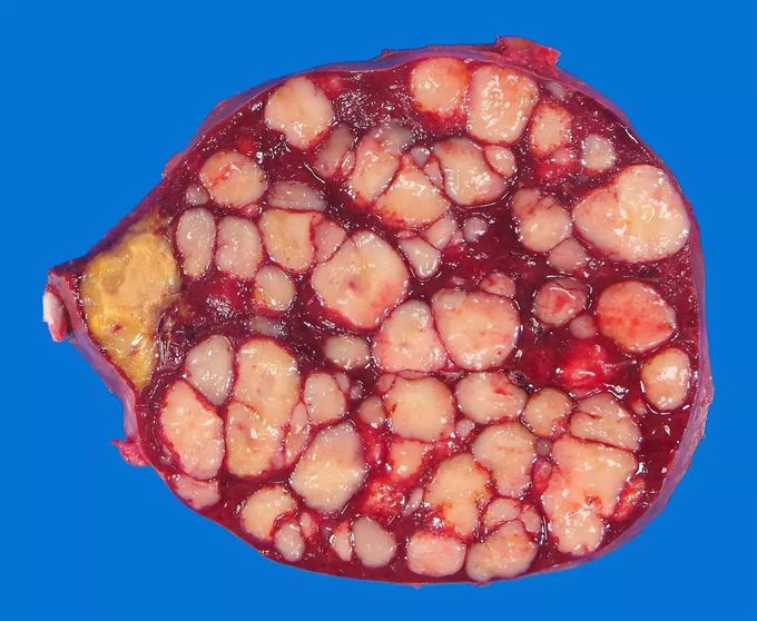 Diffuse Large B-cell Lymphoma