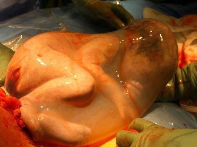 Baby born “en-caul”