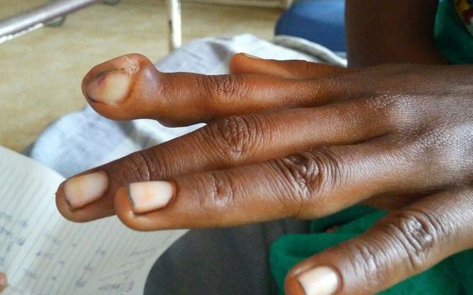 Tuberculous dactylitis