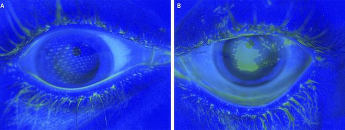 Bilateral Corneal Abrasions from Airbag Deployment