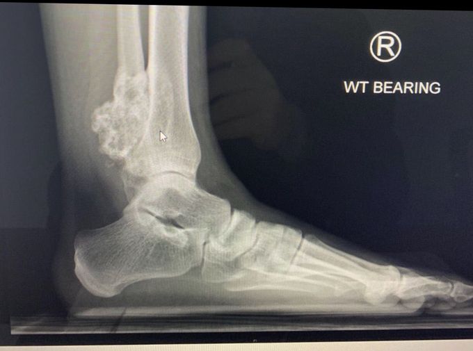 Xray - hard mass on lateral ankle