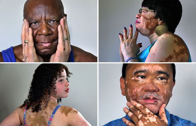 Vitiligo