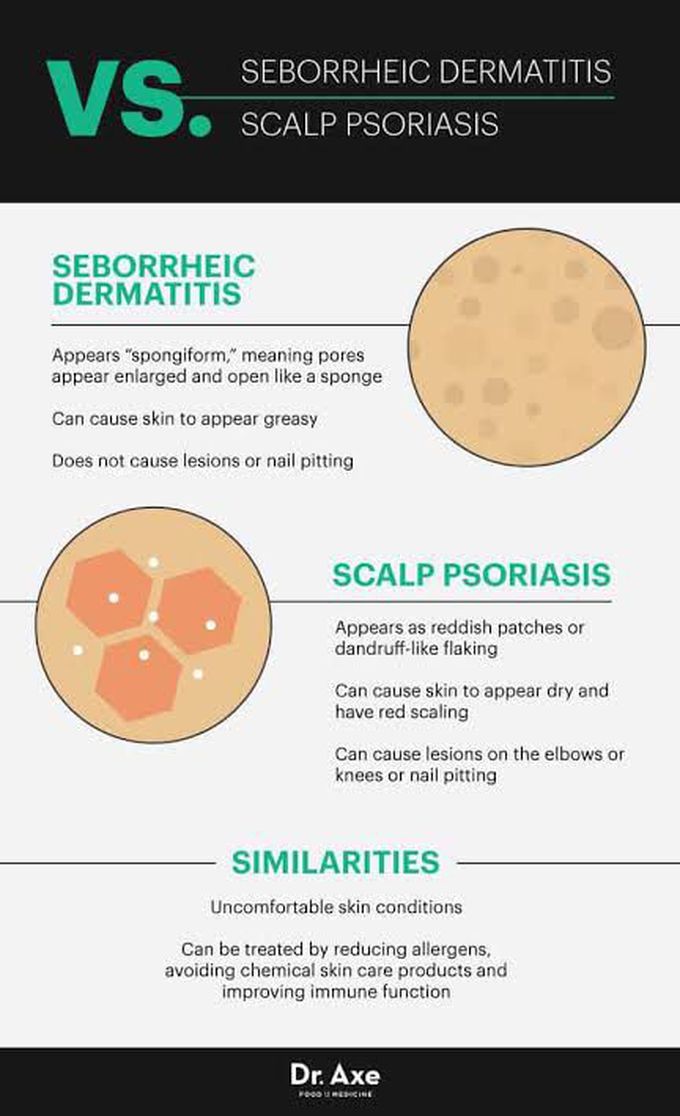 Seborrheic Dermatitis vs scalp psoriasis