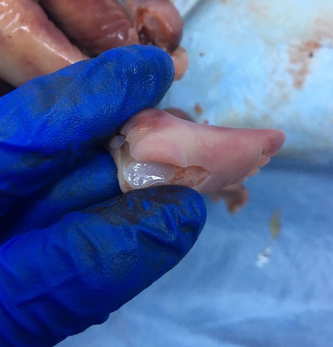 Intrauterine death
