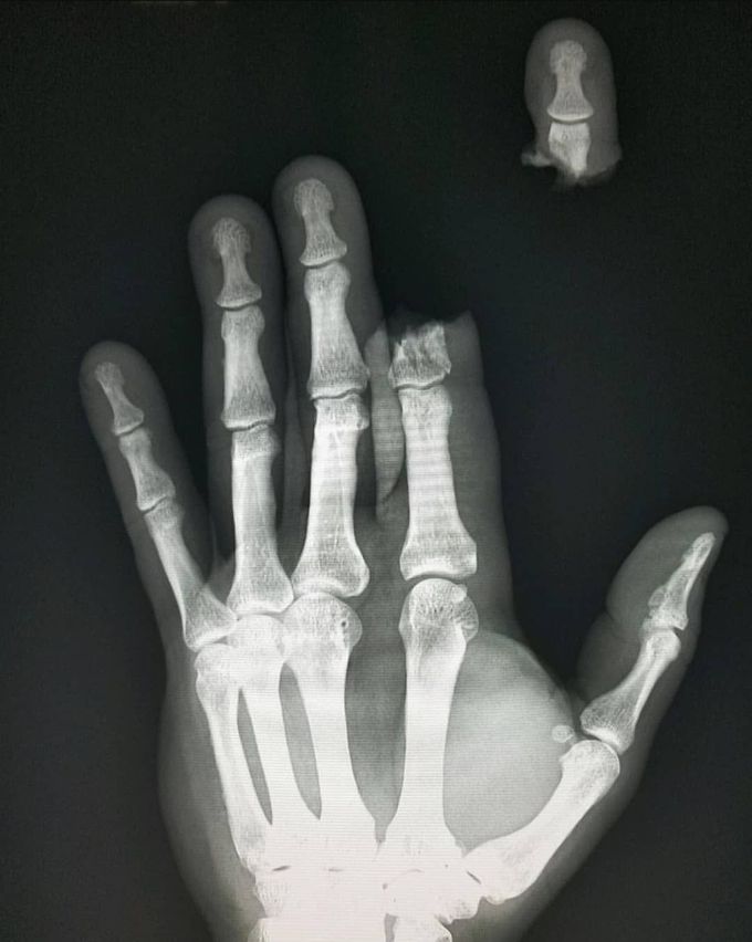 Hand x-ray showing complete second finger amputation after an accident using a powertool! 
