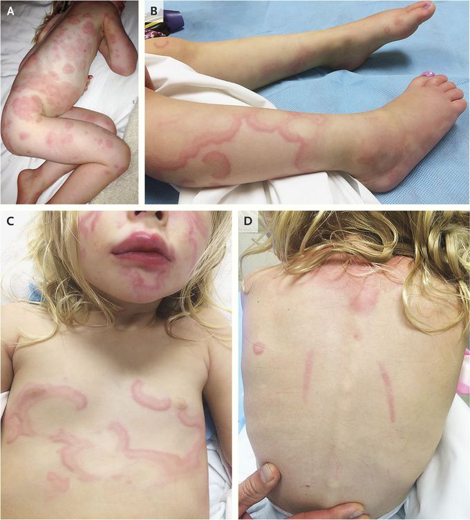 Urticaria Multiforme