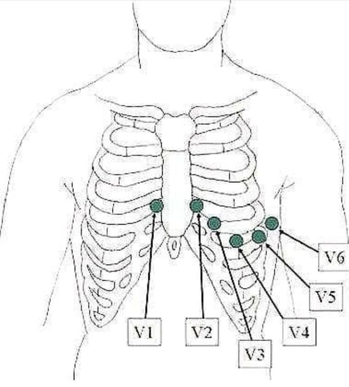 ECG Electrodes Placement