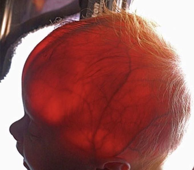 Transillumination of a newborn's head