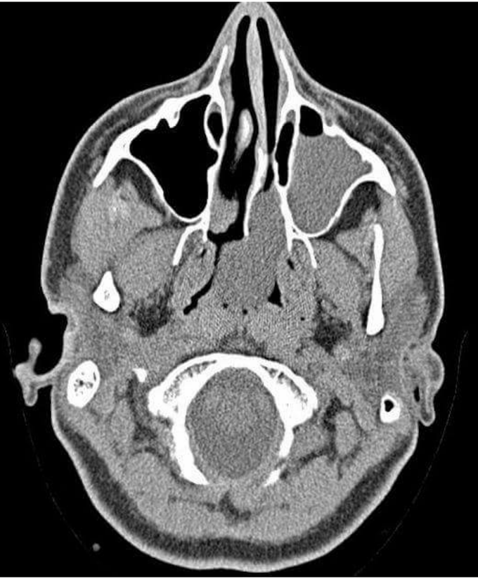 Diagnosis ?