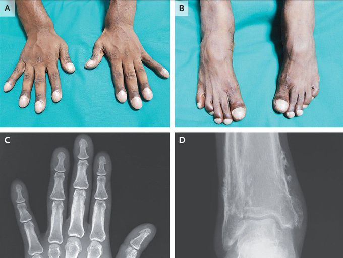 Primary Hypertrophic Osteoarthropathy