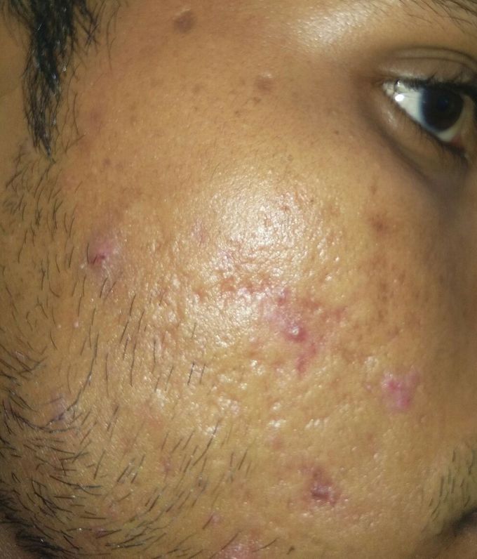 acne skin disease