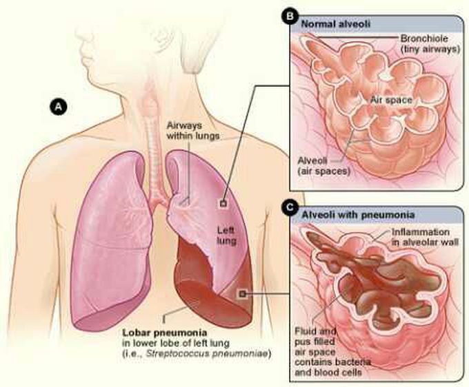 #pneumonia#