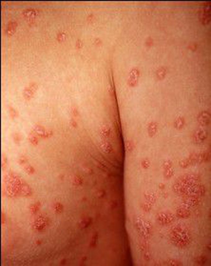 Cause of Guttate psoriasis