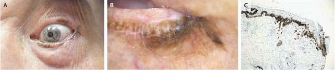 Eyelid Melanoma