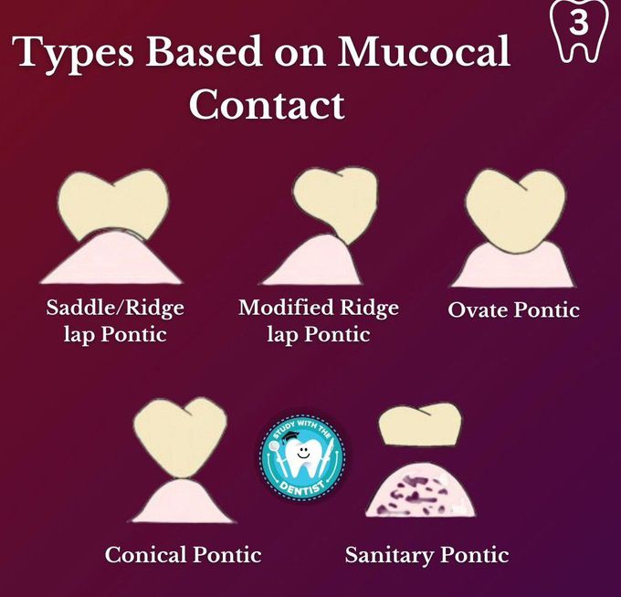 Types of Pontics