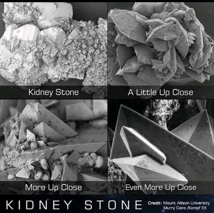 Kidney stone