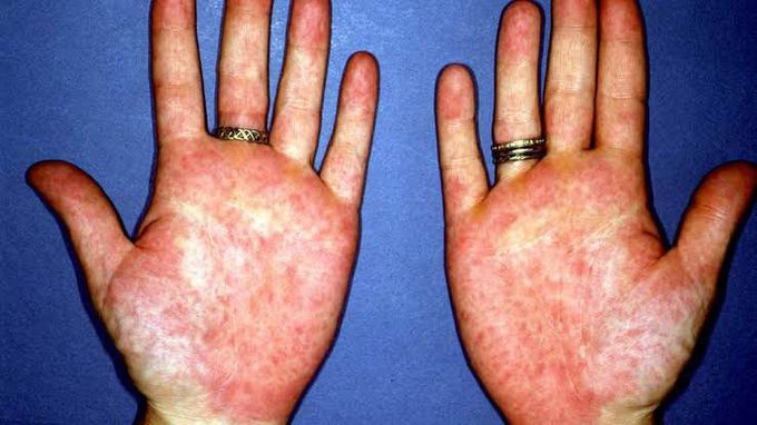Palmar erythema