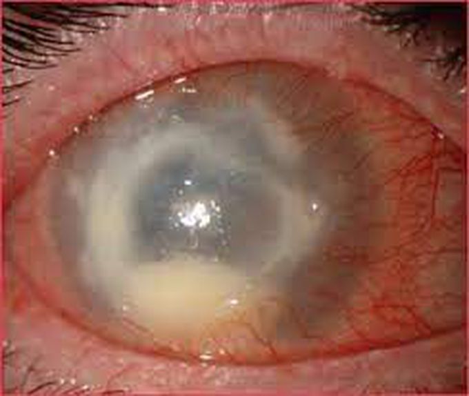 Acanthamoeba Keratitis Ring Abscess and Differential Diagnosis