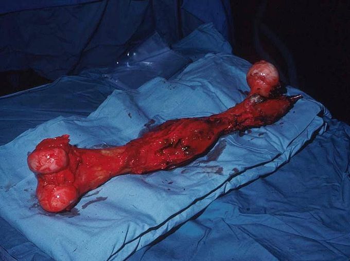 Total femur removal due to Ewing's sarcoma. 