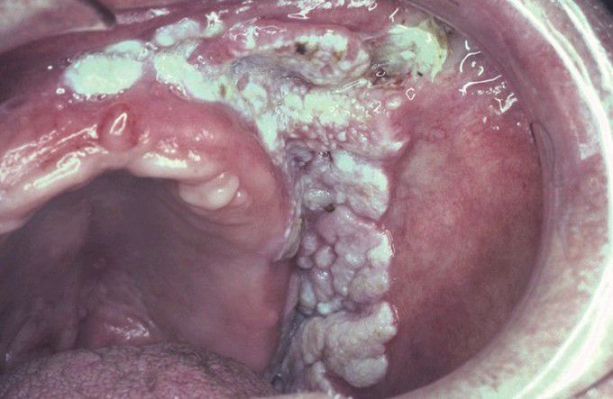 Verrucous Carcinoma.