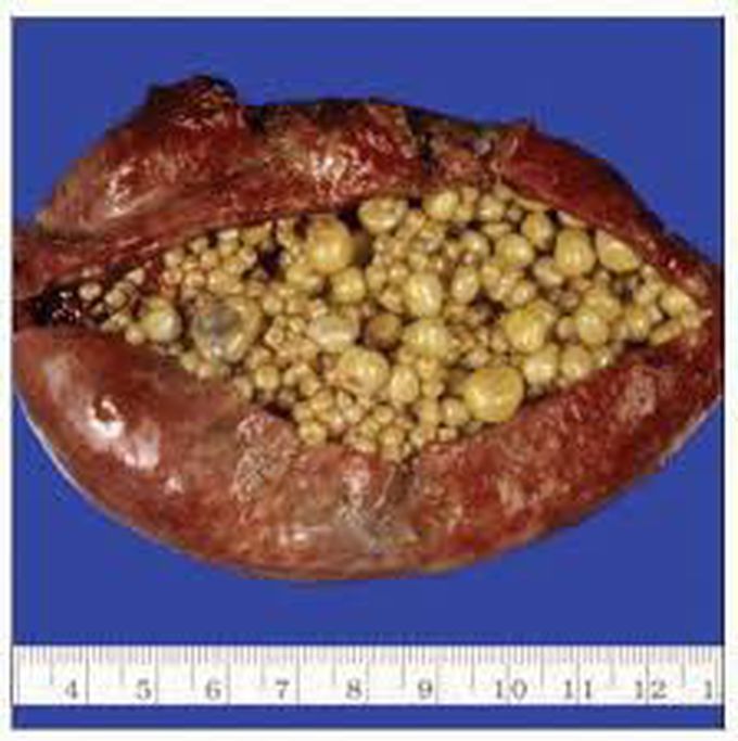 Cholelithiasis treatment