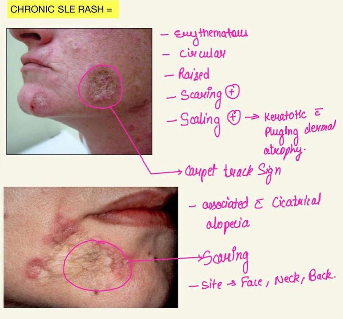 SLE- Chronic Rash