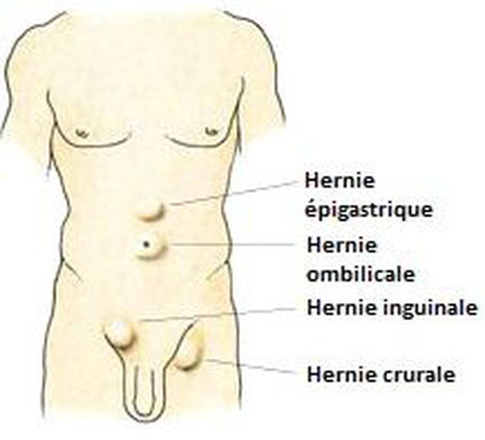 Hernie