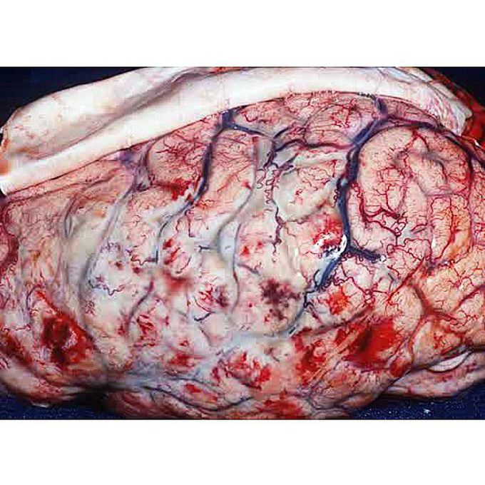 A creamy purulent exudate covers the cerebral hemispheres during meningitis