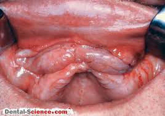 cause of denture induced hyperplasia