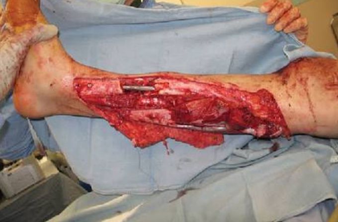 AN EXTREME TRAUMA CASE