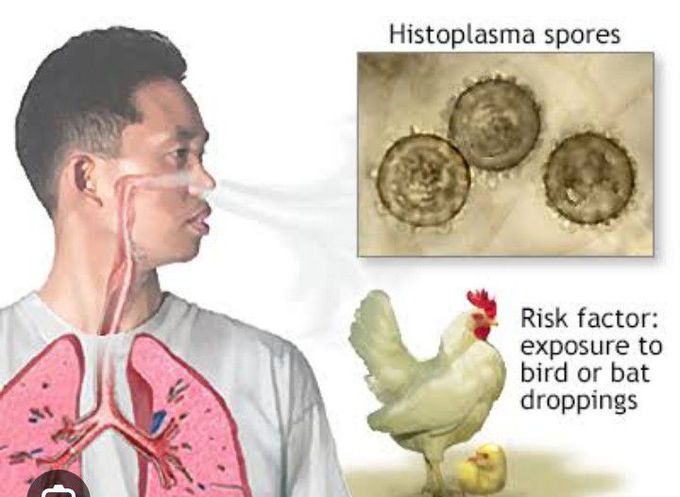 Histoplasmosis