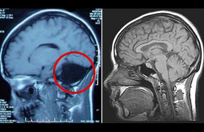 Congenial cerebellar absence