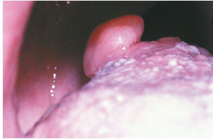 Osseous Choristoma.