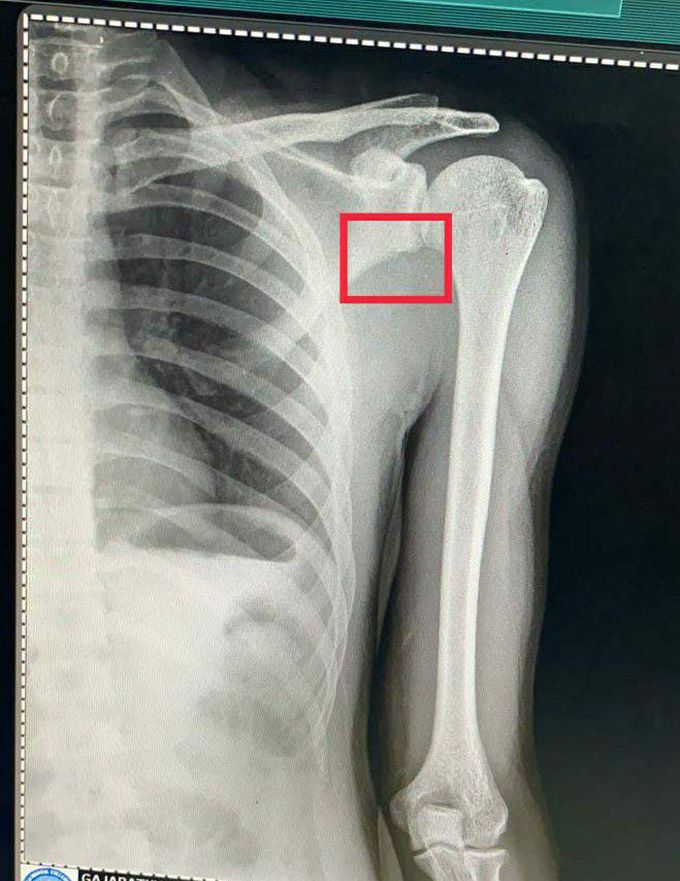 X ray chest PA view