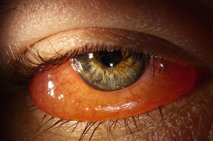 Chemosis