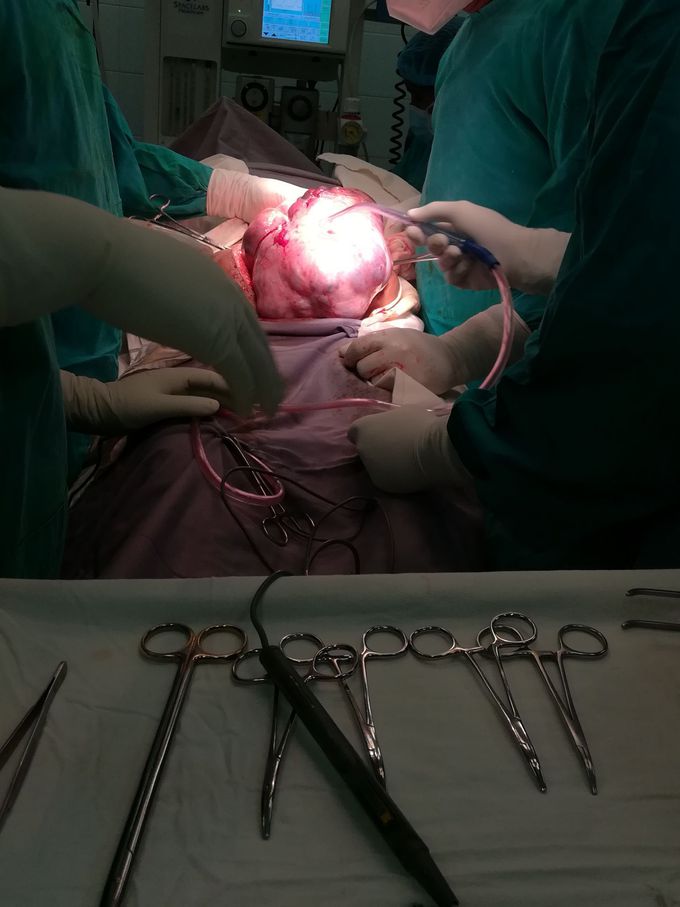 Large ovarian tumor