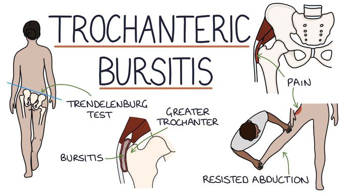 Trochanteric Bursitis