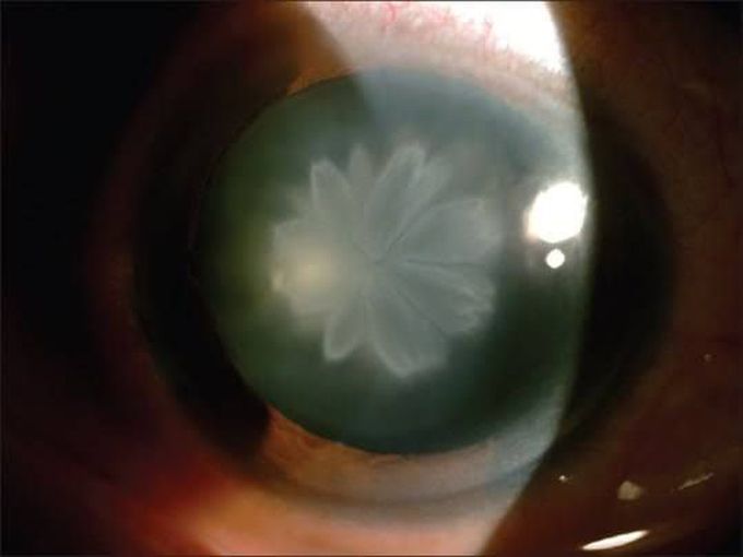 Rosette Cataract