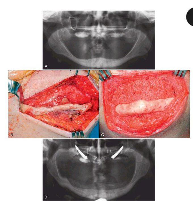 Augmentation of atrophic edentulous mandible.