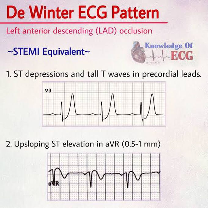 De Winter ECG pattern