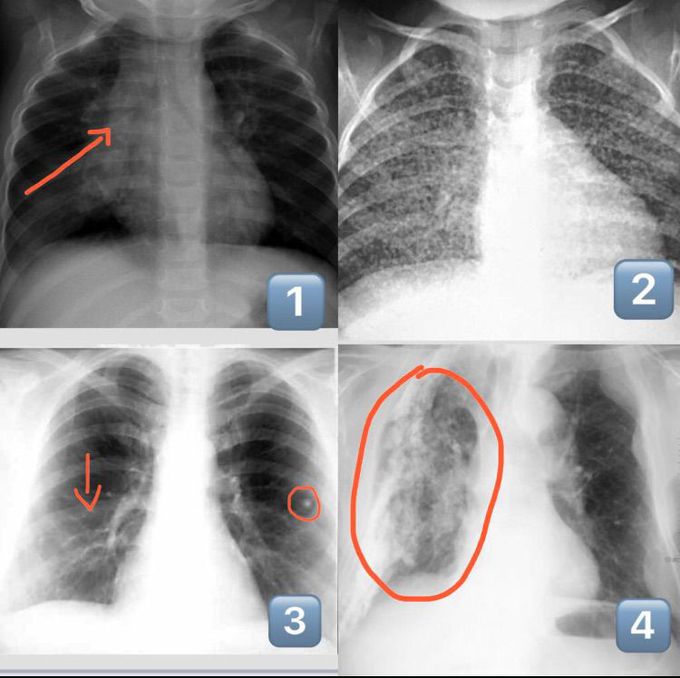Tuberculosis