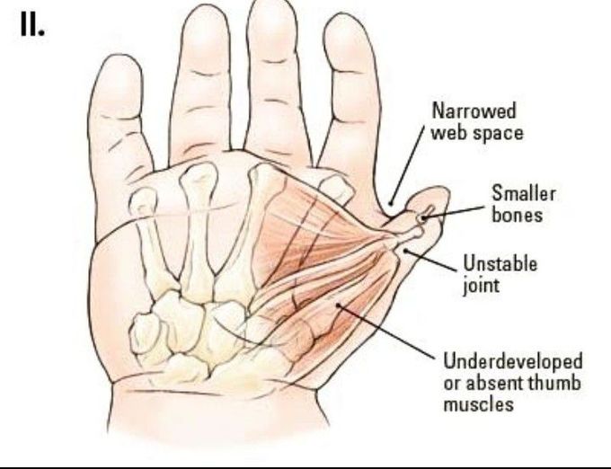 Hypoplasia of thumb