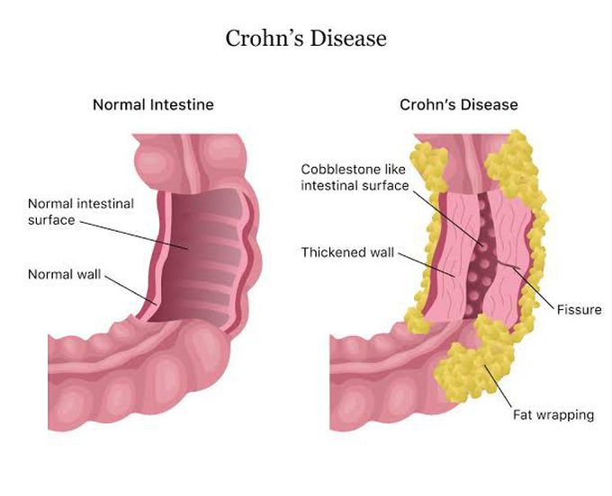 Crohns disease causes