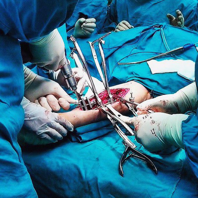Open reduction and internal fixation (ORIF) - part 2